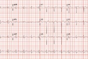 Left Ventricular Aneurysm in Urgent Care