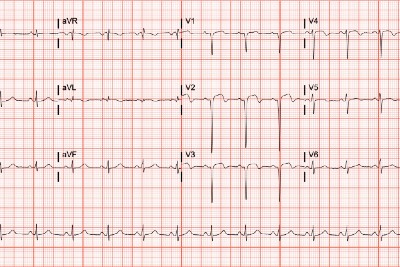 60-Year-Old With Prior Myocardial Infarction