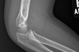 Elbow Pain Following a Fall