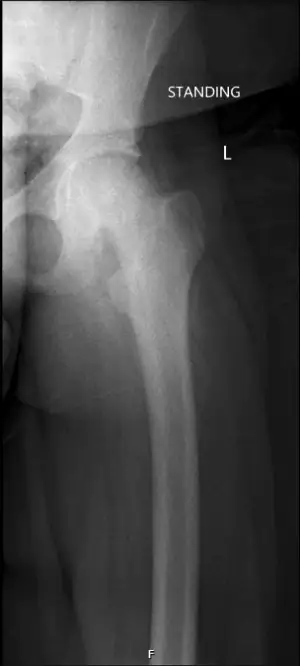 Slipped Capital Femoral Epiphysis and Calf Pain Image