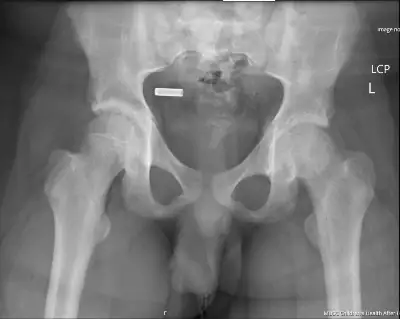 Bilateral X-ray Slipped Capital Femoral Epiphysis