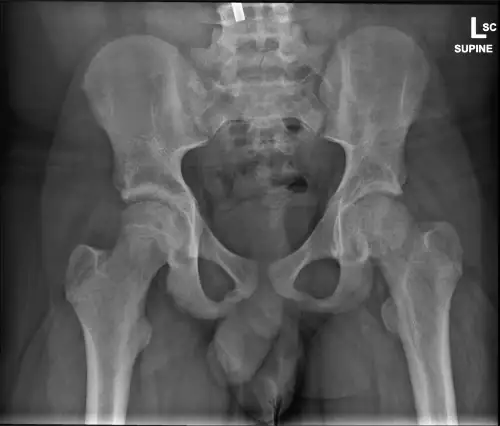 ED X-ray of Hips
