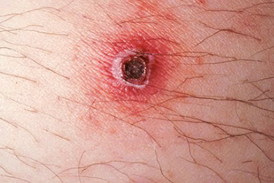 45-Year-Old Male With Arm Lesion, Headache, and Malaise