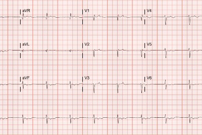 55-Year-Old With Lower Extremity Edema