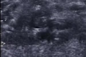 DVT in Urgent Care with POCUS