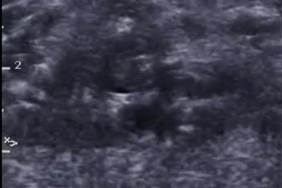 52-Year-Old With Calf Pain After Travel