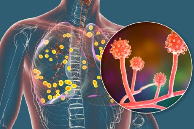 Histoplasmosis Outbreak