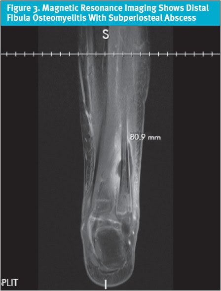 Case Report of Osteomyelitis in Urgent Care