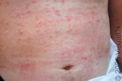 42-Year-Old Male With Widespread Rash, Cough and Vomiting 42-Year-Old Male With Widespread Rash, Cough and Vomiting