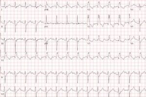 Trifascicular Block in Urgent Care