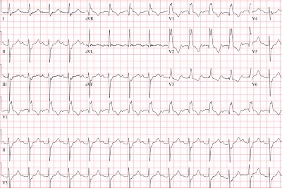 61-Year-Old With Chronic Kidney Disease