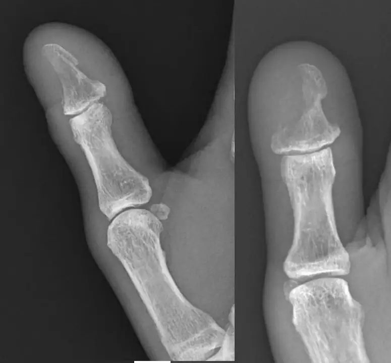 Osteomyelitis of the first digit X-ray