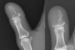 Osteomyelitis of the first digit