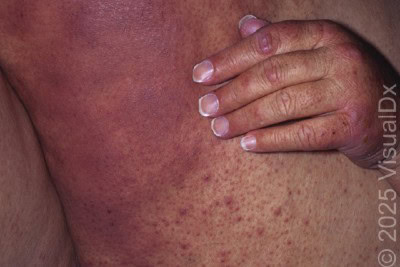 A Rash and Fever Following a Bone Marrow Transplant