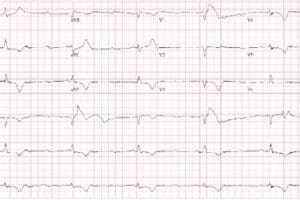 Complete Heart Block ECG Case