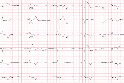 75-Year-Old With History Of Hypertension And Diabetes