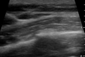 POCUS Rib Fracture Case