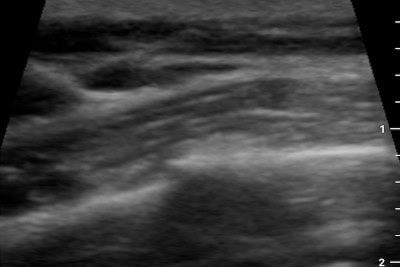 51-Year-Old With Chest Pain After a Skiing Fall