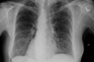 Bronchiectasis in Urgent Care