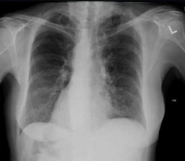 Bronchiectasis in Urgent Care