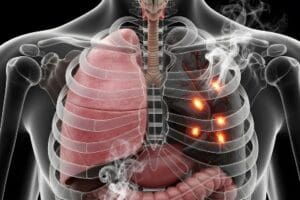 Lung Cancer Screening in Urgent Care