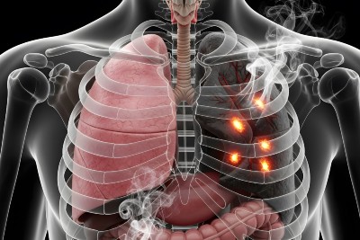 Potential Impact of Urgent Care Providers in Facilitating Lung Cancer Screening