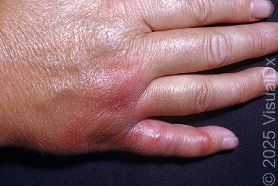 53-Year-Old Butcher With Red Rash Following a Cut to the Hand 53-Year-Old Butcher With Red Rash Following a Cut to the Hand
