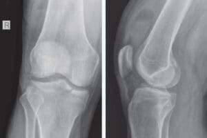 Tibial plateau fracture after a Fall