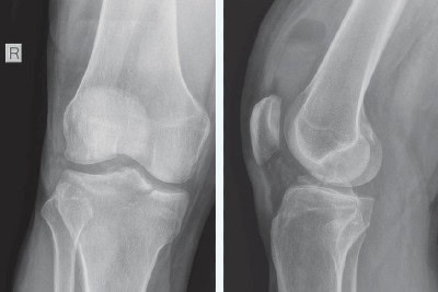 38-Year-Old Male With Knee Pain After a Fall