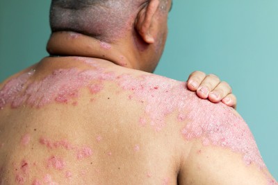 Oral Medication for Plaque Psoriasis