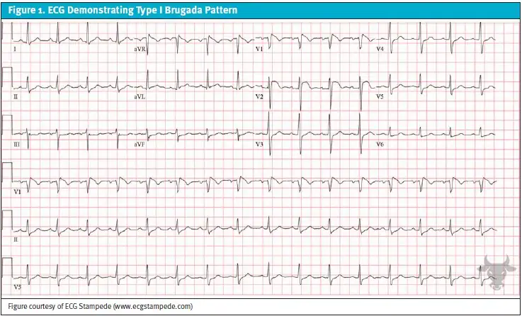 Brugada Syndrome in Urgent Care