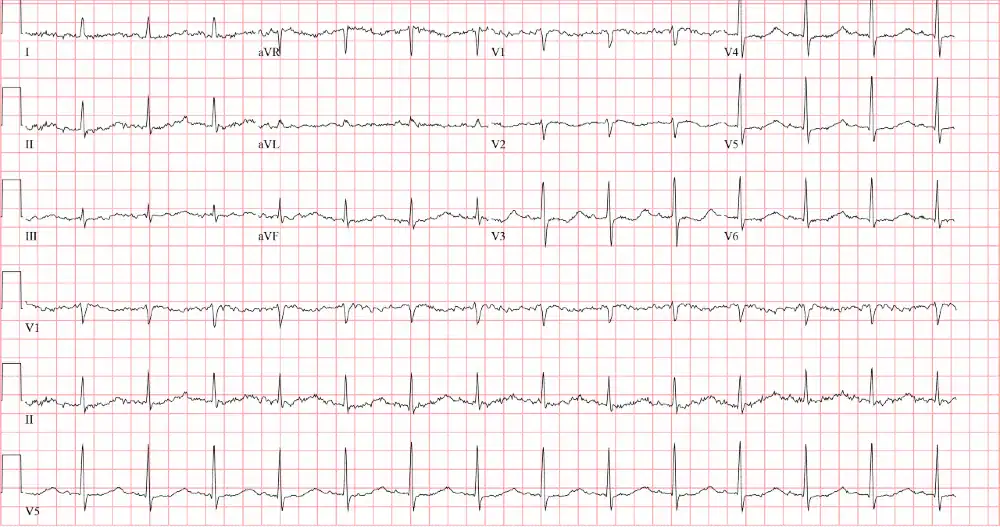 Hypokalemia ECG Case in Urgent Care