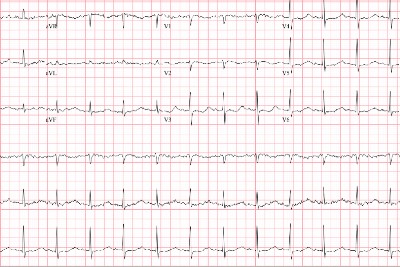55-Year-Old With Frequent Falls