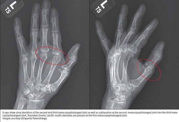 Rheumatoid Arthritis Case X-ray Images