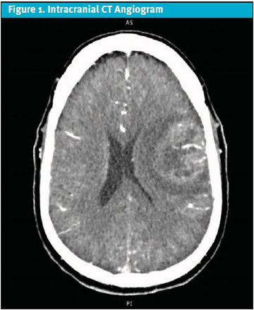 Intracranial CT Angiogram