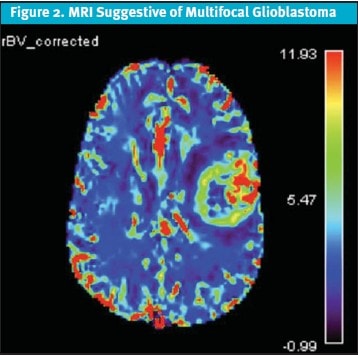 Glioblastoma in Urgent Care MRI Suggestive of Multifocal Glioblastoma