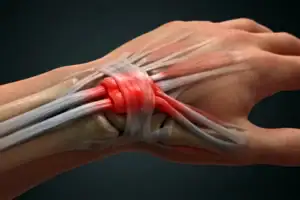 De Quervain Tenosynovitis in Urgent Care