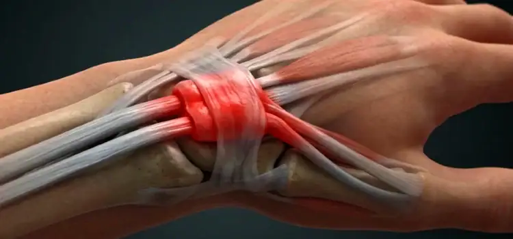 Urgent Care Evaluation and Management of De Quervain Tenosynovitis
