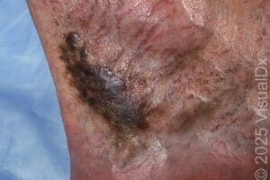 Acroangiodermatitis in Urgent Care