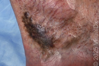 67-Year-Old Man With Dark Patch on Ankle