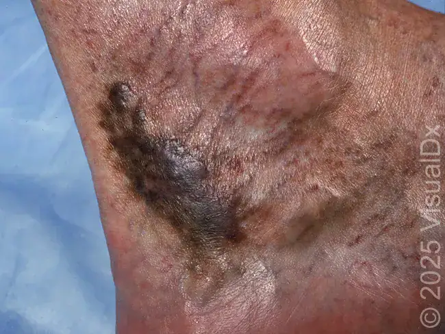 Acroangiodermatitis in Urgent Care
