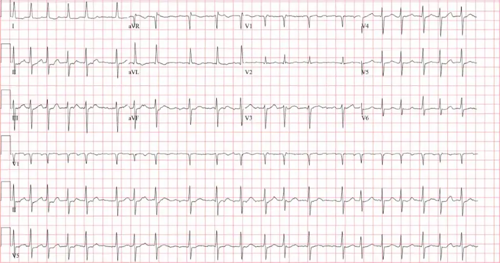 atrial fibrillation in 84 year old