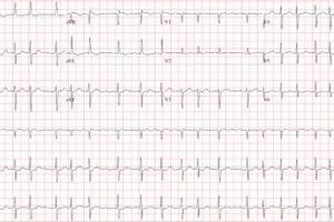 atrial fibrillation in 84 year old