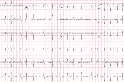 84-Year-Old With Palpitations