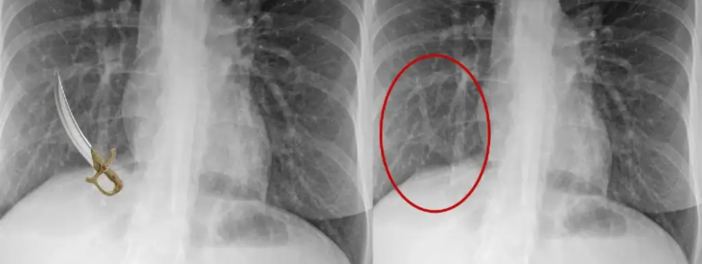 PAPVR in Urgent Care