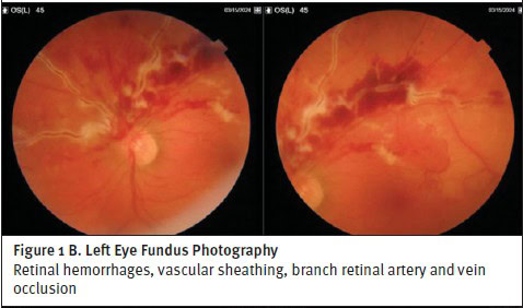 Behçet Disease