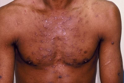 39-Year-Old Male With Itchy Rash to Chest