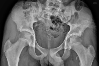 12-Year-Old Boy With Left Groin and Buttock Pain 12-Year-Old Boy With Left Groin and Buttock Pain