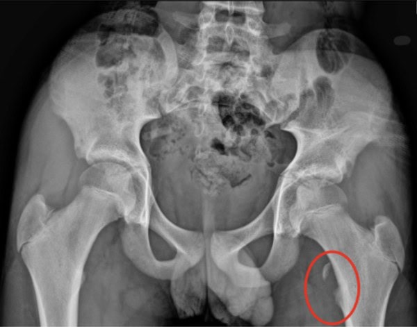 Lesser Trochanter Avulsion Fracture in Urgent Care