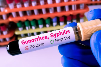 Gonorrhea and Syphilis Cases Surge in Europe